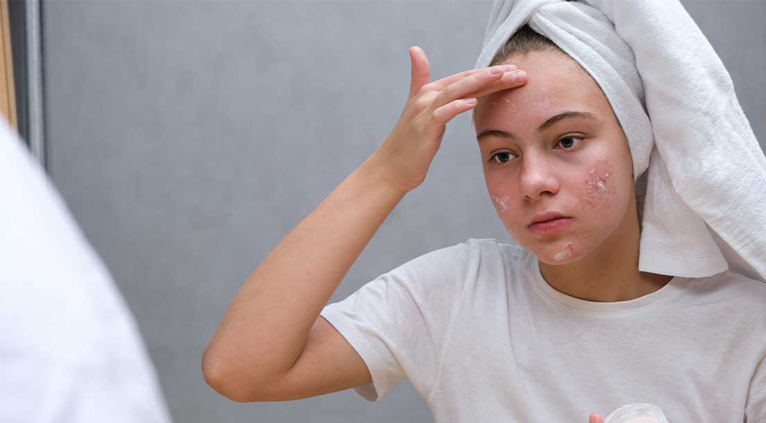 Cancellare le imperfezioni: prodotti acne - una recensione dei migliori cosmetici